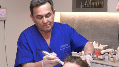 MICRONEEDLING-CAPILAR-PLAY